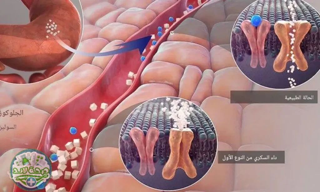 ما هو مستوى السكر المثالي في دم مريض السكري من النوع الأول؟