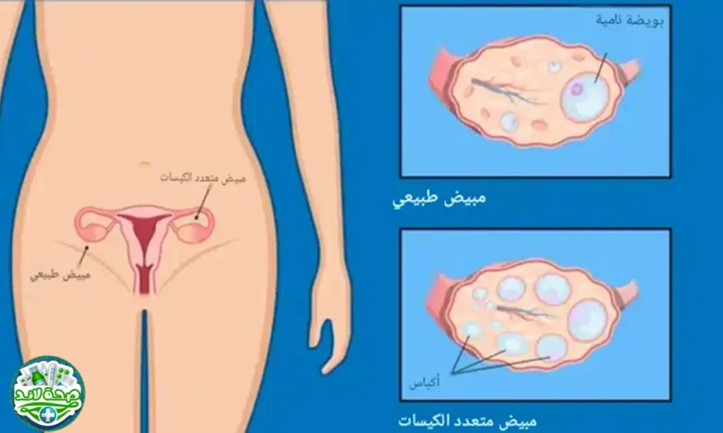 ما الفرق بين المبيض الطبيعي (Normal Ovary) والمبيض المصاب بمتلازمة تكيس المبايض (PCOS)؟