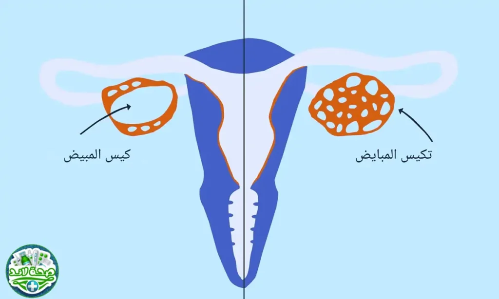 ما الفرق بين تكيس المبايض وأكياس المبيض؟