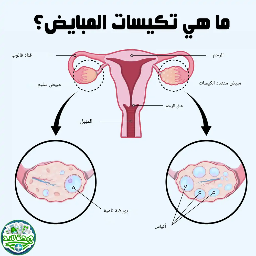 ما هي تكيسات المبايض؟ وهل هي مرض واحد أم أكثر من حالة؟